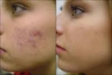 Acne/Deep Cleansing